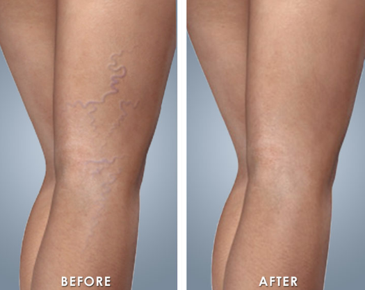 sclerotherapy-treatment-south-florida-cardiovascular-specialists-1-1