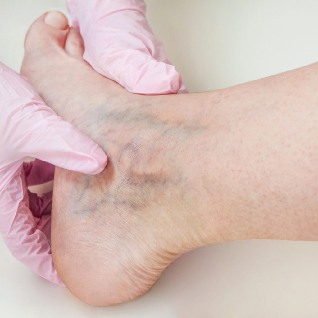 VeinGogh Treatment for Spider Veins