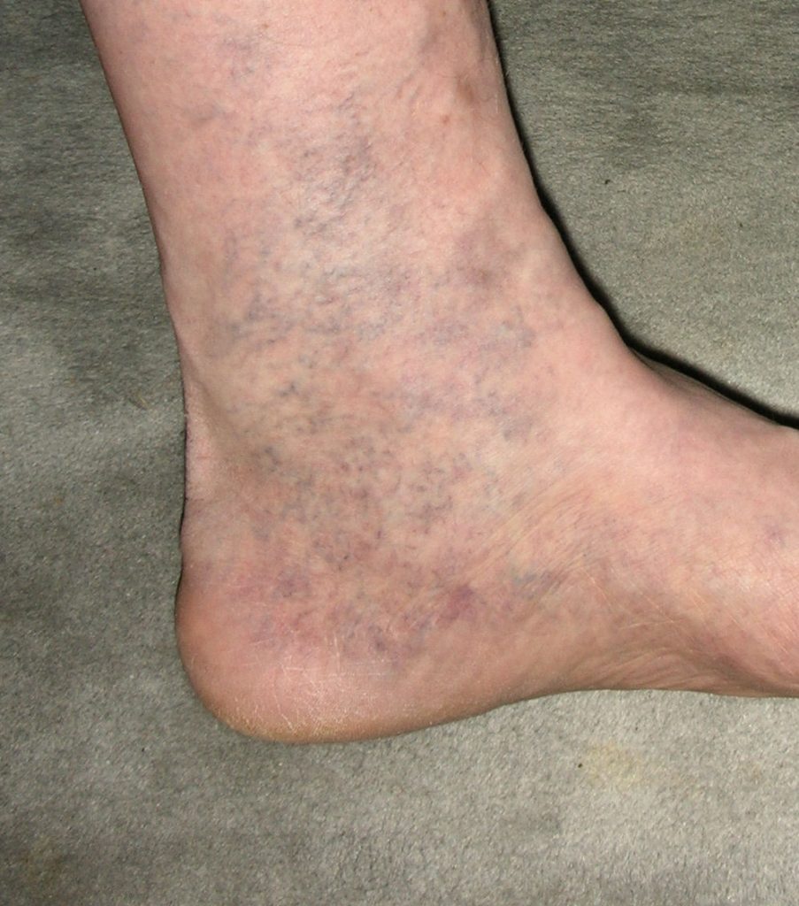 VeinGogh Treatment for Spider Veins