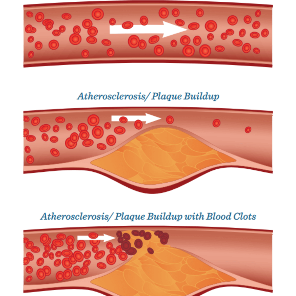 Атеросклероз (закупорка кровеносных сосудов). Атеросклеротический атеросклероз. Атеросклеротическая бляшка. Холестериновые бляшки в сосудах.
