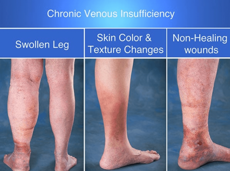 Discolored Skin You May Have Chronic Venous Insufficiency
