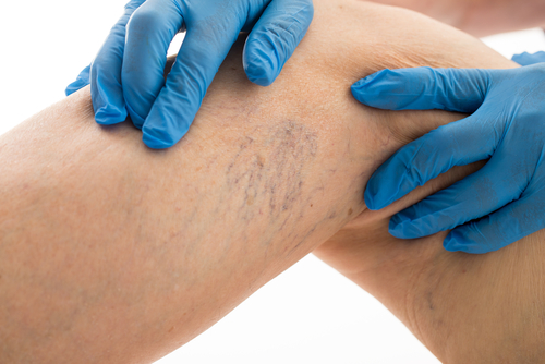 Chronic Venous Insufficiency - South Florida CardioVascular Specialists