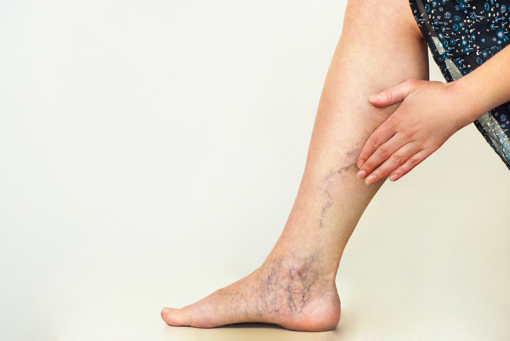 Varicose Veins On Image & Photo (Free Trial)